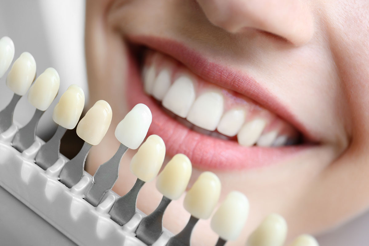 ¿Quieres dientes más blancos? Estos son los métodos seguros y los hábitos que pueden arruinar tu sonrisa