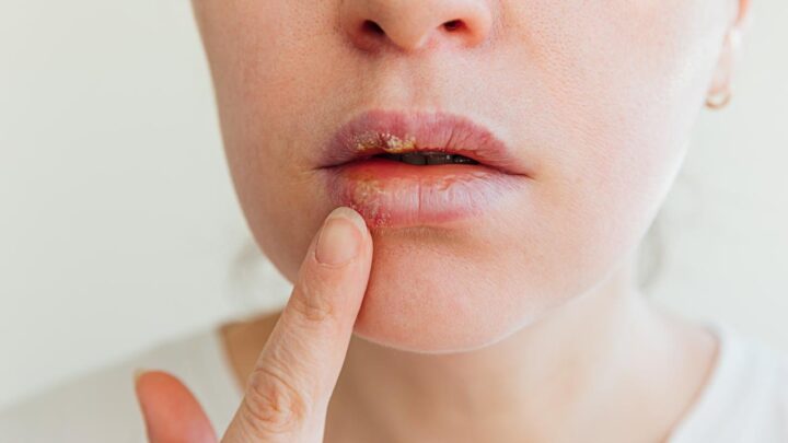 FDA aprueba un nuevo fármaco contra el herpes resistente: así funciona el pritelivir